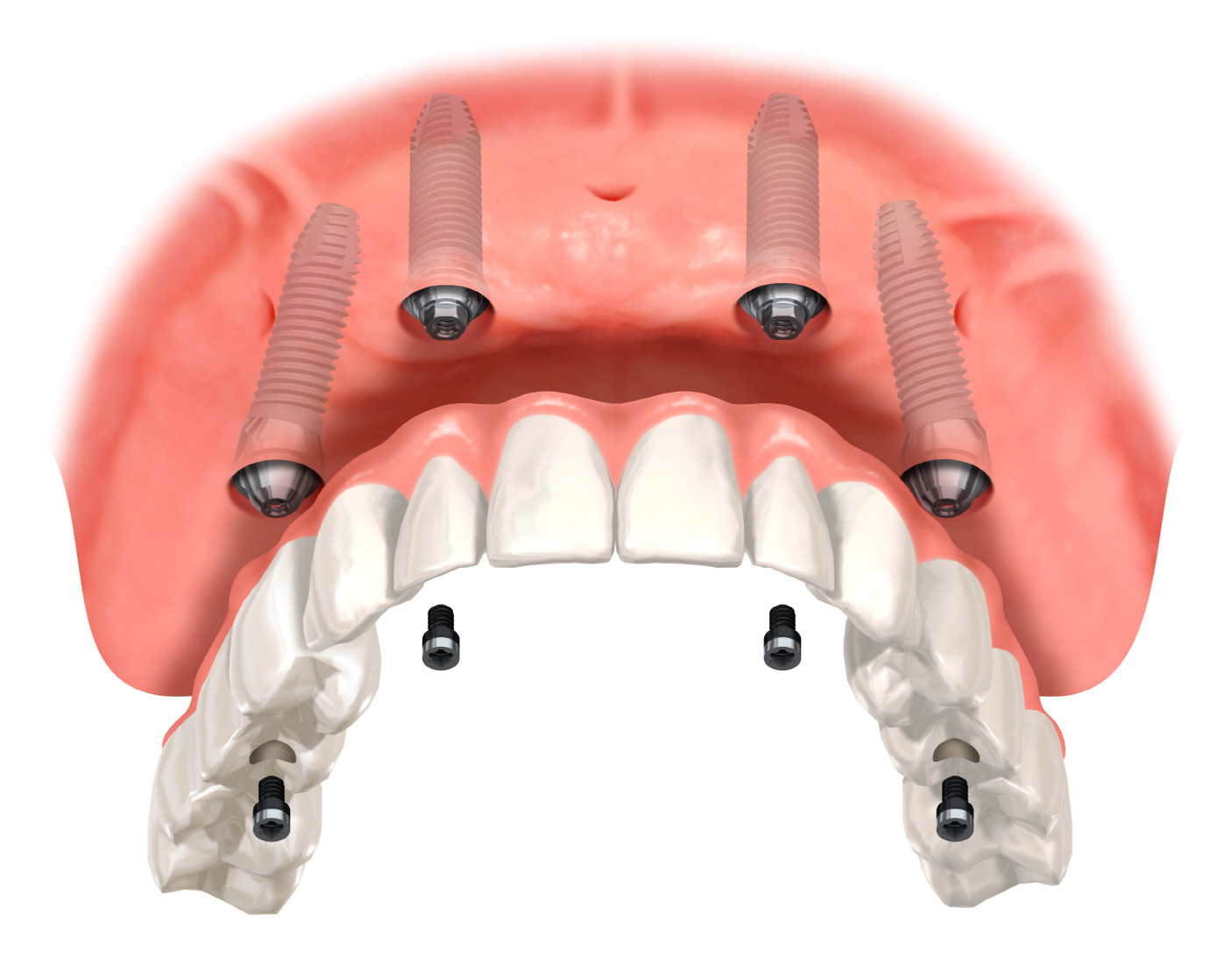 Schablonengeführte Implantatchirurgie